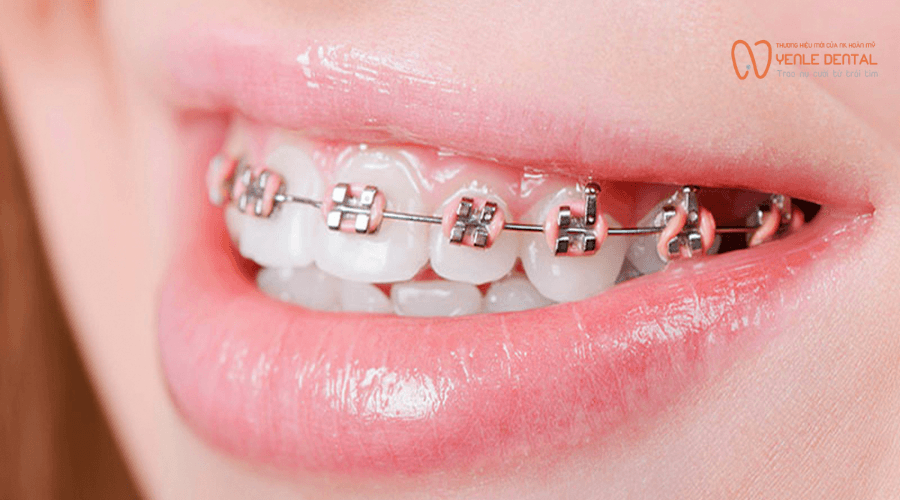 niềng răng 1 hàm có được không